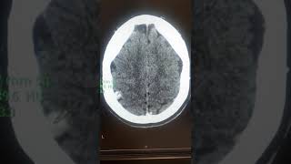 meningioma ctscan [upl. by Dame]