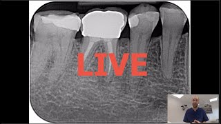 Commentaires LIVE  Retraitement endodontique  46 couronne tenons fibrés condensation verticale [upl. by Botti]