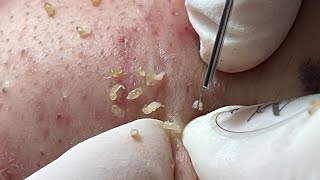 Blackheads in every hole  ACNE TREATMENT MAI NGOC 💖💖💖 [upl. by Viradis]