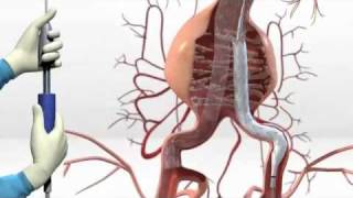 Simulacion Stent Endurant AAA de Medtronic [upl. by Amitie]