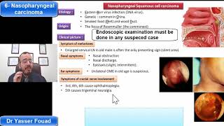 6 Nasopharyngeal Carcinoma [upl. by Nuoras]