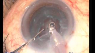 Phacoemulsification with foldable intraocular lens implantation under topical anesthesia [upl. by Euqininod282]