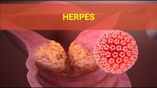 Herpes Symptoms – Causes Symptoms and Pictures of HSV Herpes Cold Sores in Men women [upl. by Aicul223]