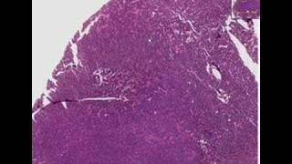 Histopathology LungSmall cell carcinoma [upl. by Belinda]