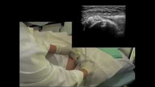 Calcific Subscapularis Tendinitis  QMH AED Ultrasound Casebook 201209 Video 3 [upl. by Eedya]