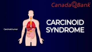 Carcinoid Syndrome [upl. by Rachael5]