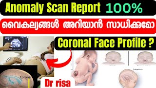 Anomaly Scan Malayalam5th Month Scan In Pregnancy [upl. by Aliekat]