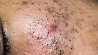 POPPING BLACKHEADS ON FACE NEWEST BLACKHEADS VIDEOS 2021 [upl. by Audie]