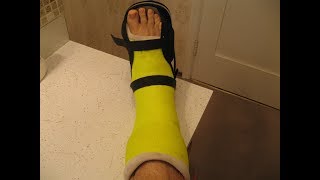 Ankle Injury 2G Cast removal flaky skin and muscle atrophy [upl. by Genesa]