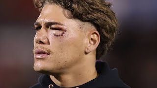 NRL News Reece Walsh Eye injury [upl. by Hulburt]