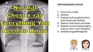 🧑🏽‍⚕️ chest x ray normal Learn The Basics About chest x ray [upl. by Ahsiemaj]