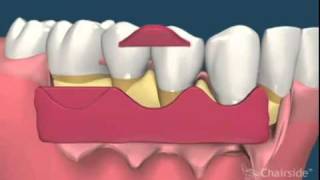 8 Retraccion de encias gingivales Tratamiento [upl. by Lanny]