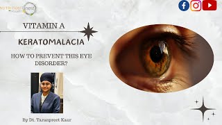 Keratomalacia  VITAMIN A  EYE CARE  How to Prevent Vitamin A Deficiency [upl. by Eserehc11]