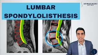 Lumbar Spondylolisthesis  Anatomy Symptoms Causes Treatments and more [upl. by Rotow520]