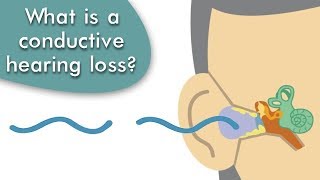 Conductive Hearing Loss Explained [upl. by Arreit56]