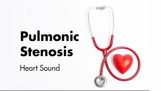 Pulmonary Stenosis aka Pulmonic Stenosis  Heart Sounds  MEDZCOOL [upl. by Frodine]