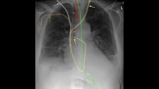 Chest Xray Lines and Tubes in 5 minutes [upl. by Olumor992]