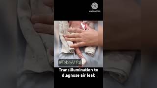 Transillumination to diagnose air leak l Pneumothorax neonatology [upl. by Ettelimay447]