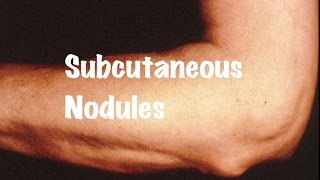 Brief information on Subcutaneous Nodules [upl. by Cooley]