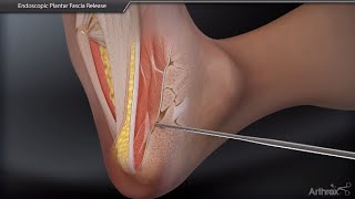 Endoscopic Plantar Fascia Release [upl. by Rasaec764]