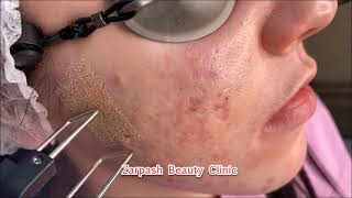 The best way to get beautiful even skin at Zarpash beauty clinic [upl. by Seabury]