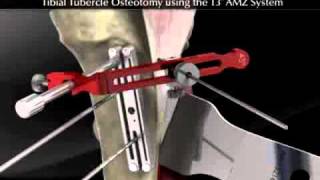 Tibial Tubercle Osteotomy using the T3 AMZ System [upl. by Tybald764]