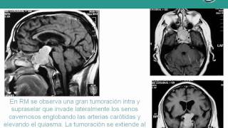 NeurorgsnetMacroadenoma de Hipófisis [upl. by Evangeline]