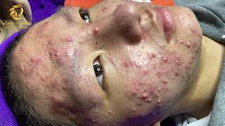 Treatment of acne tablets pustules and blackheads 358  Loan Nguyen [upl. by Kalina]