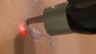 Tattoo removal in action [upl. by Lednahc]