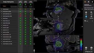 Adaptive Hybrid Surgery—OntheFly Radiosurgery Assessment [upl. by Ieppet468]