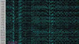 ELECTROENCEFALOGRAMA DE 32 CANALES INTERFAZ A PC EEG KT883200 YouTube 360p [upl. by Caughey]