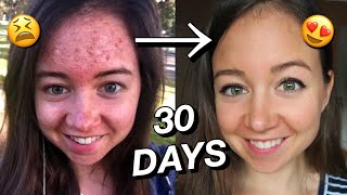 HOW I CLEARED MY SKIN NATURALLY ☁️💫 30 day transformation [upl. by Zamir953]