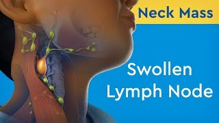 Neck Mass Swollen Lymph Node [upl. by Atteroc73]