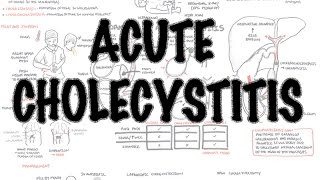 Acute Cholecystitis  Overview signs and symptoms pathophysiology treatment [upl. by Scheld300]