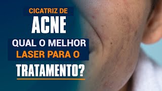 Cicatrizes de Acne  Qual o melhor laser para o tratamento [upl. by Radcliffe]