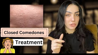 Closed Comedones Treatment  with a simple daily routine [upl. by Adle]