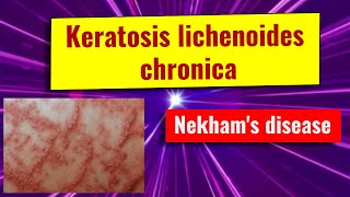 Keratosis lichenoides chronica overview causes features management [upl. by Ziegler890]