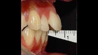 Non Surgical Orthodontic treatment of Skeletal Class II with 7mm Overjet [upl. by Bathesda]