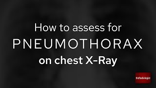 How to look for a pneumothorax on a frontal chest Xray [upl. by Surazal]