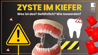 Zyste im Kiefer  Was ist das Entstehung Therapie und Folgen  Carree Dental Köln [upl. by Barbur932]