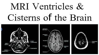 MRI ventricle and cisterns of the Brain [upl. by Worrad291]