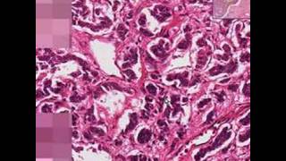 Histopathology LungBronchial carcinoid [upl. by Festa]