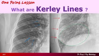 Kerley Lines on Chest PA Radiographs [upl. by Waverly949]