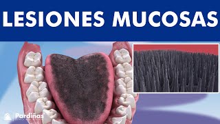 Lengua geográfica liquen plano leucoplasia y otras lesiones de mucosa oral © [upl. by Isabeau267]