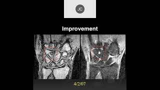 MRI of the Wrist Part 14  Wrist Inflammation [upl. by Map]