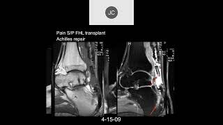 MRI of the Ankle Part 8 – Ankle Tendons [upl. by Mailiw]