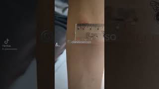 mantoux test positive lebih dari 10mm [upl. by Carpet101]