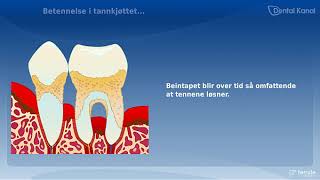 Periodontitt [upl. by Damaris]