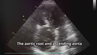 48YearOld Male with Aortic Dissection Rapid Diagnosis and Intervention [upl. by Notliw350]