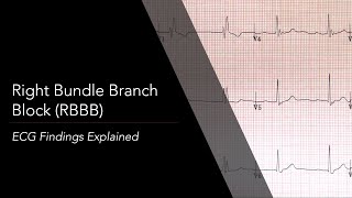 Right Bundle Branch Block RBBB ECG [upl. by Mulligan]